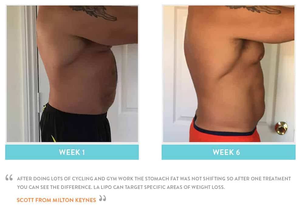 Before & After Stomach Fat Darlington