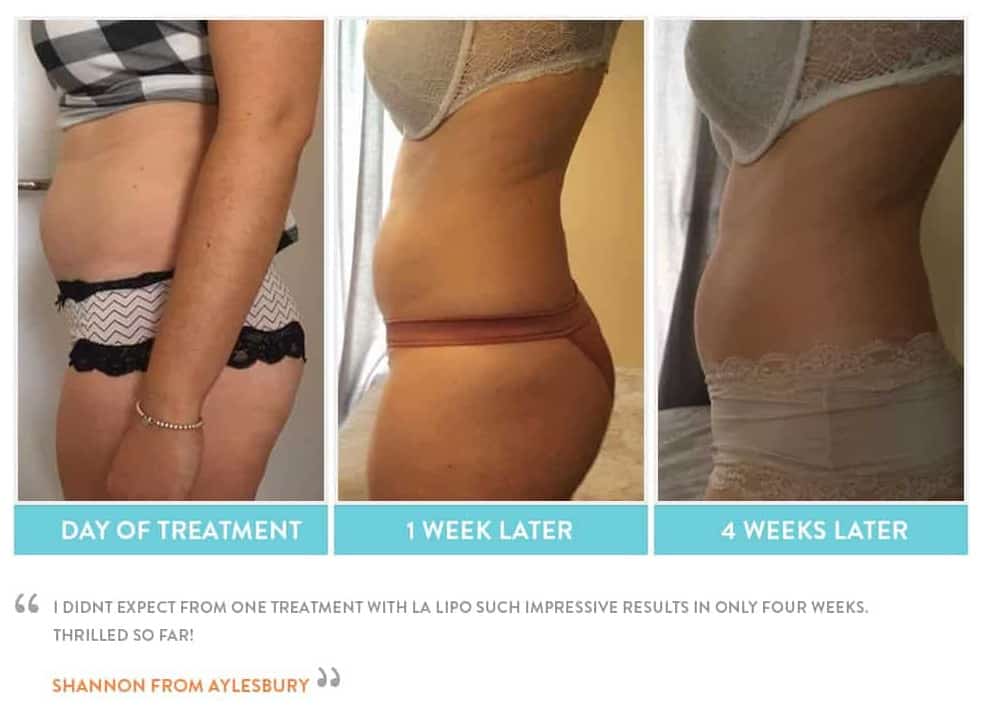 before, Cryolipolysis Darlington