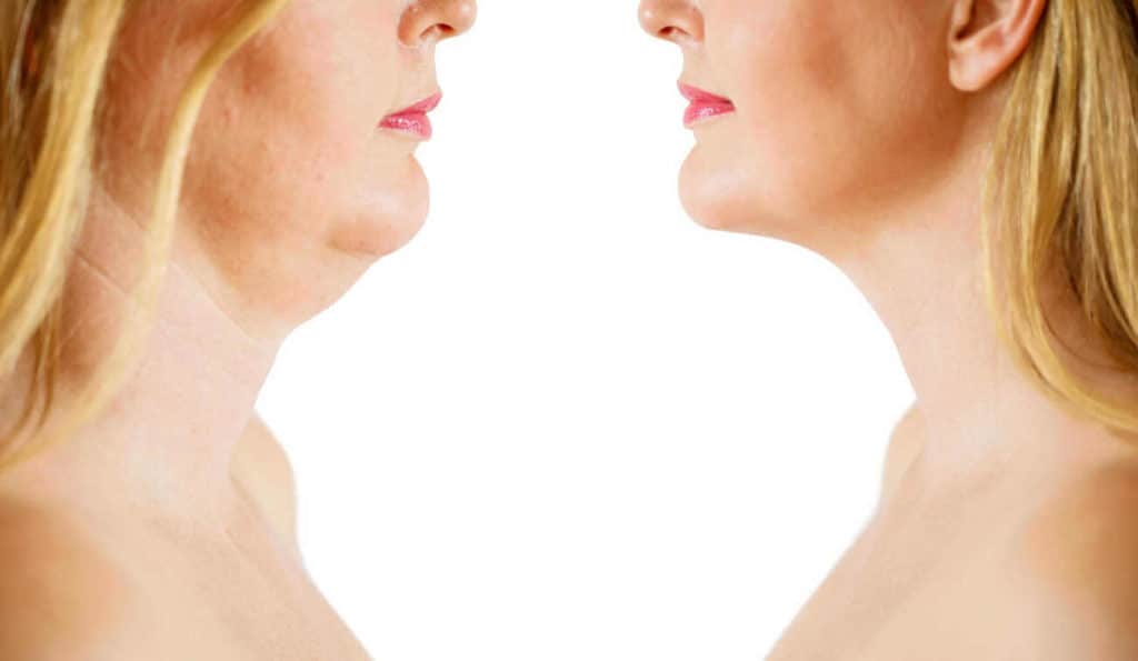 Double Chin treatment Darlington before and after results