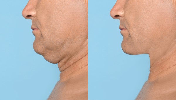 Which Non-Surgical Treatments Work Best for Jowls and Loose Skin Darlington?