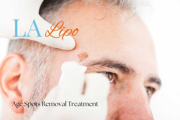 What Are the Most Effective Treatments for Age Spots Darlington?