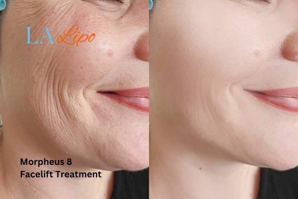 Morpheus8 Treatment Darlington for flawless skin! Call us today!
