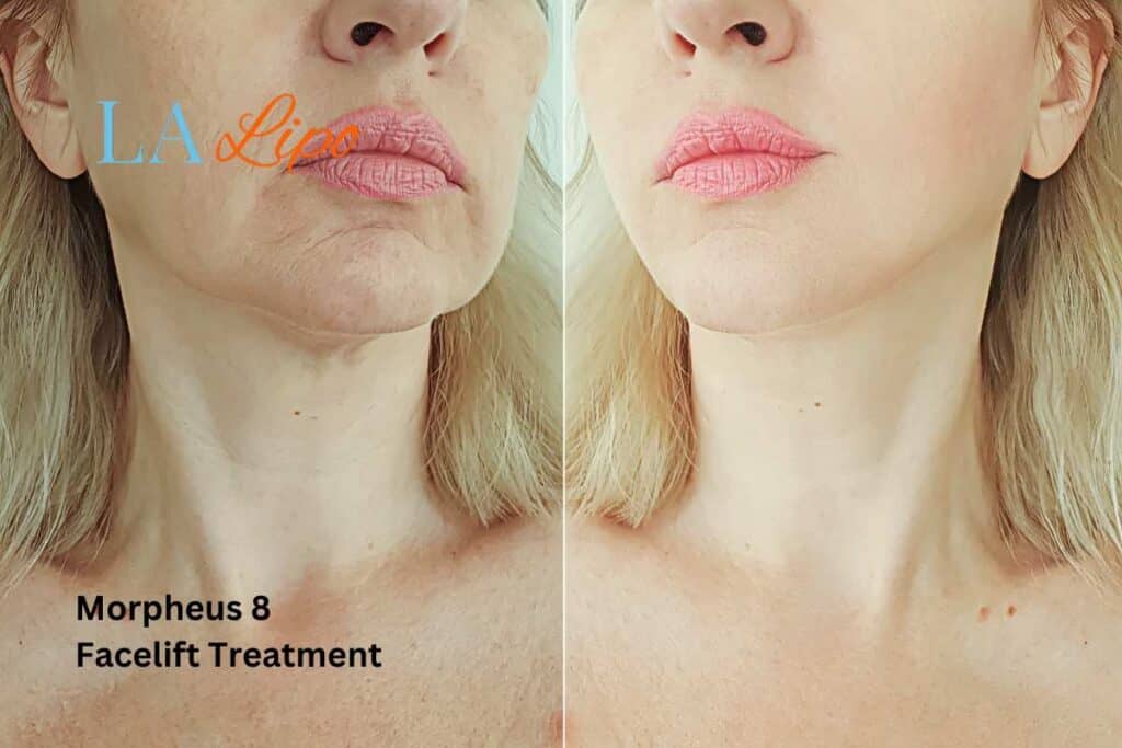 Turn back time with Morpheus8 Treatment Darlington