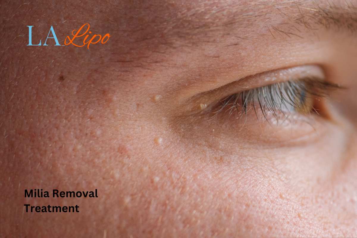 Cryopen Milia Removal: Is It the Easiest and Safest Option Darlington?