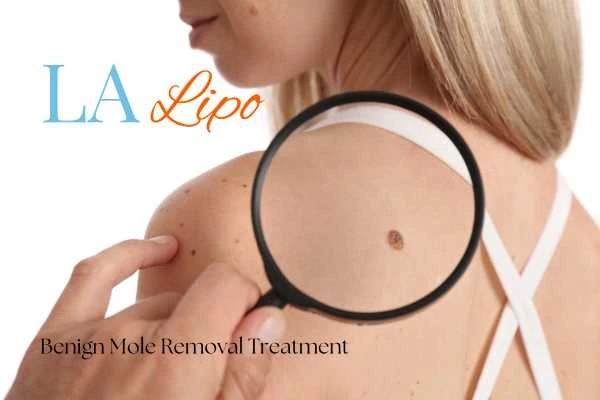 Why getting moles removed Darlington can boost your confidence!
