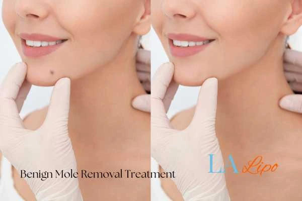 woman's before and after mole removal Darlington results