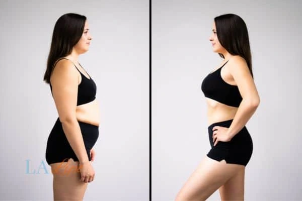 image of woman before and after results of LA-EMS Body Sculpting Darlington to help treat Diastasis recti