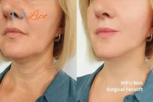 hi-fu for wrinkles Darlington before and after results