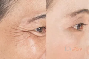 Before and after results of woman - HI-fu wrinkles reduction treatment Darlington