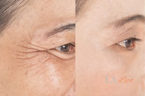 Before and after results of woman - HI-fu wrinkles reduction treatment Darlington