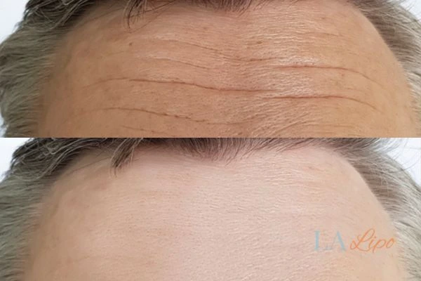 results of HIFU Darlington on mans forehead to help reduce lines and wrinkles