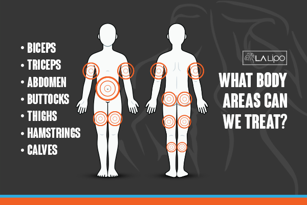 Graphic to show areas you can have LA-EMS Body Sculpting Darlington treatment.