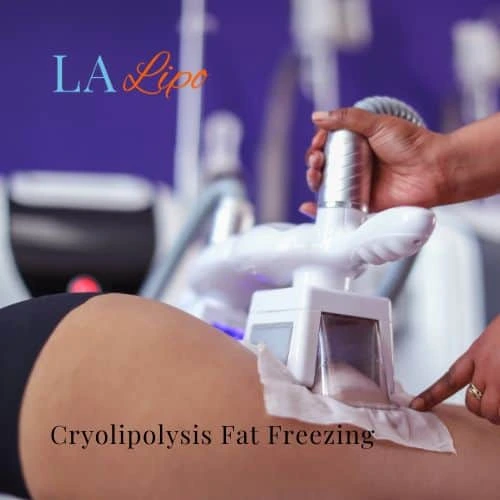 fat freezing - Cryolipolysis Darlington