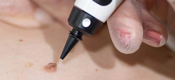 skin tag removal using cryopen Darlington