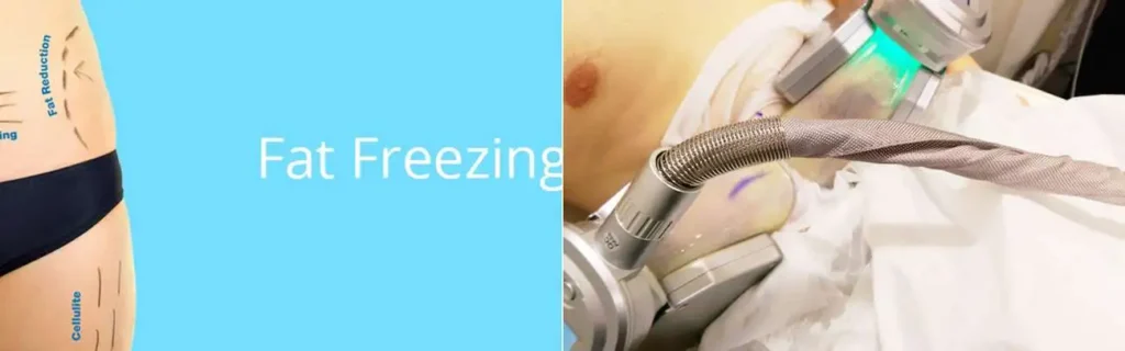 Fat freezing Darlington on multiple areas of the body