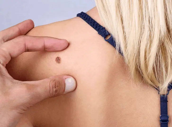 woman having mole removal Darlington consultation before treatment.