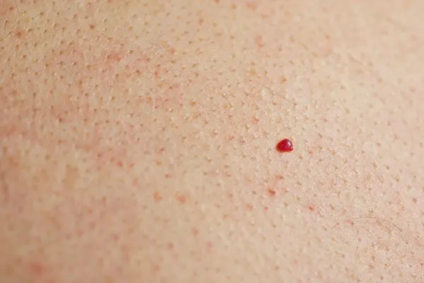close up of a cherry angioma Darlington