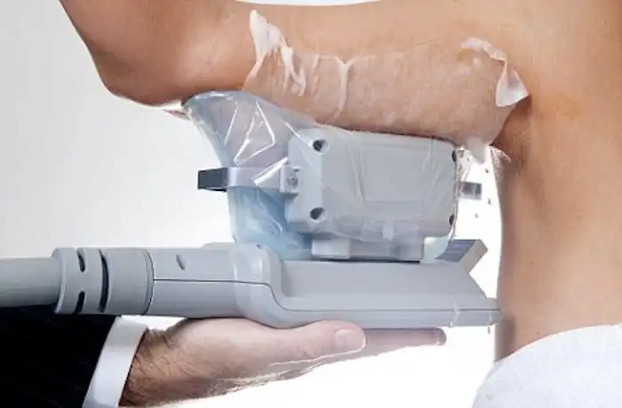 Picture of fat freezing Darlington on the upper arms.