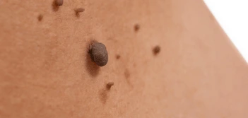 image of a skin tag Darlington