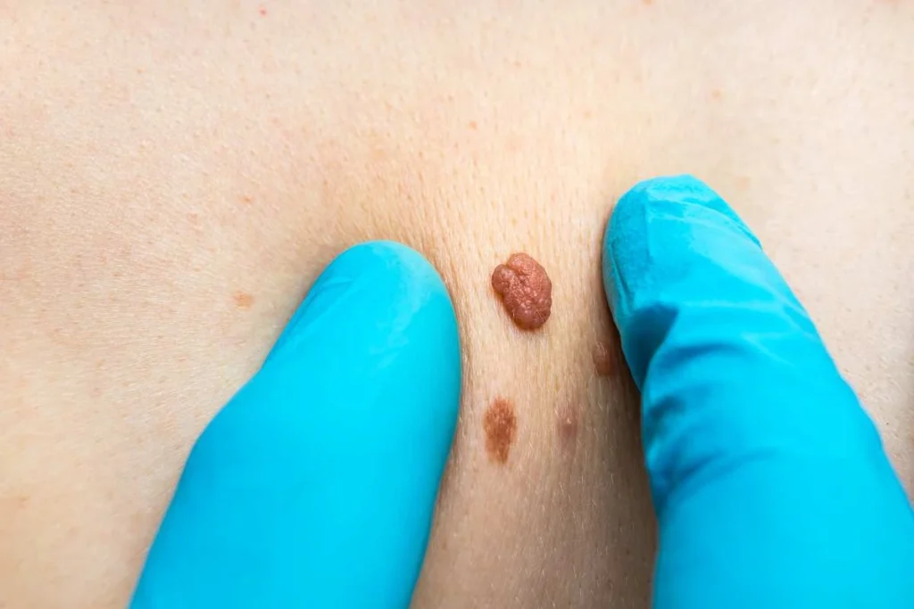 Consultant examining a skin tag Darlington
