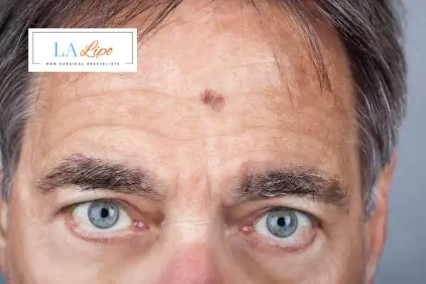 Solar Lentigo Removal Darlington image of man with mark on his forehead