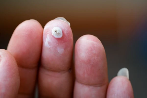 wart on person finger - cryotherapy to treat from LA LIPO Darlington