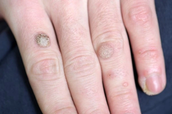 photo of warts on person hand - see wart removal Darlington from LA LIPO