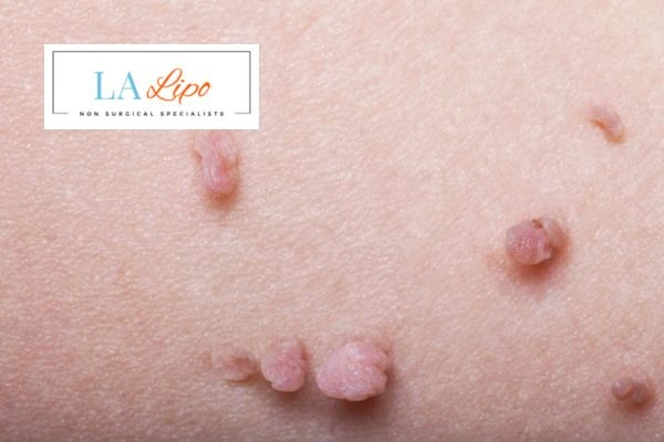 Does cryopen skin tag removal Darlington hurt? Find out now call our team today!