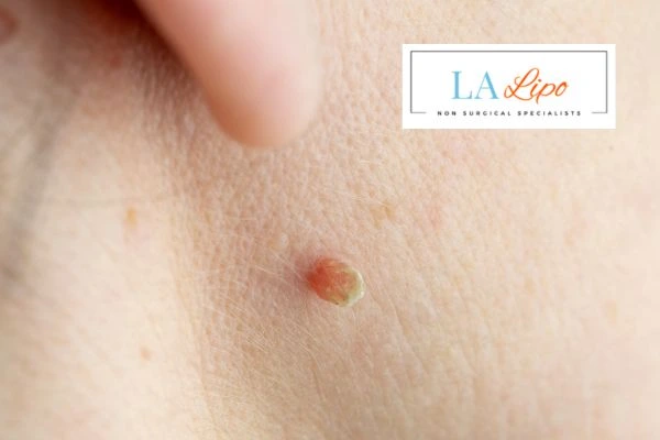 Book skin tag removal Darlington today speak to our team now!