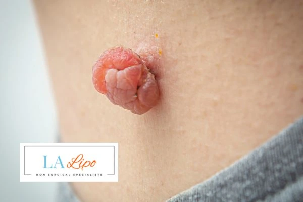 Interested in skin tag removal Darlington? Concerned about the pain? Find out more today!