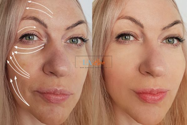 Morpheus 8 results Darlington face lift.