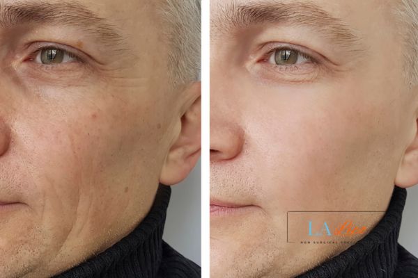 See the amazing results of Morpheus8 Treatment Darlington!
