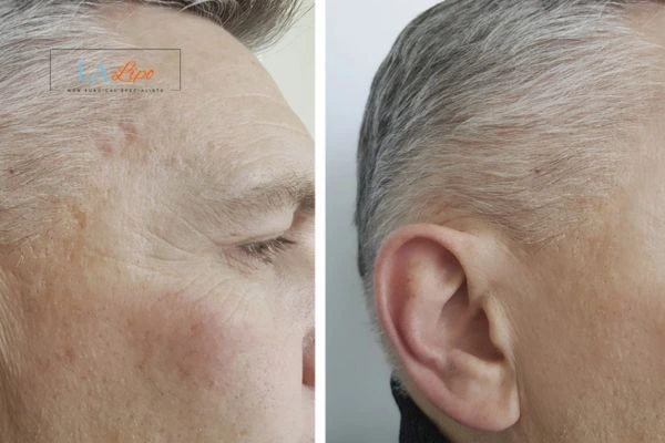 Mens Before & After Morpheus 8 Results Darlington