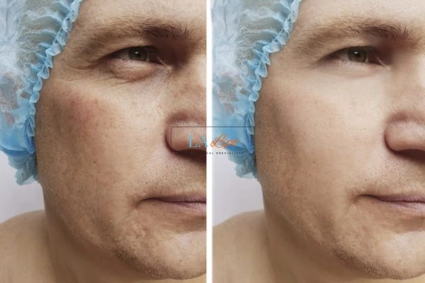 Before and after Morpheus 8 Results Darlington