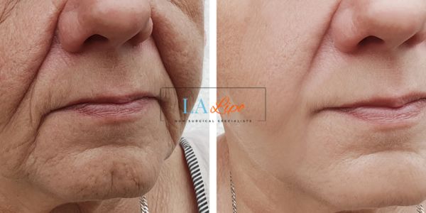 Older lady deeper wrinkle reduction - LA LIPO Morpheus 8 Results Darlington