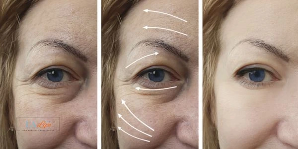 Amazing eye lift Morpheus 8 results Darlington