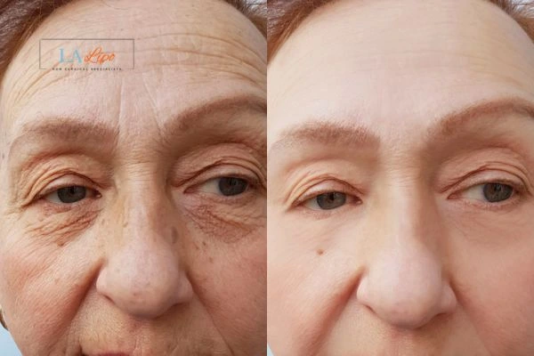 The powerful benefits of Morpheus8 Treatment Darlington - Call Our team today!