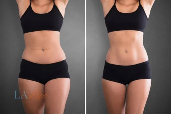 before and after results of non-surgical treatment to help a woman's body image and mental health Darlington