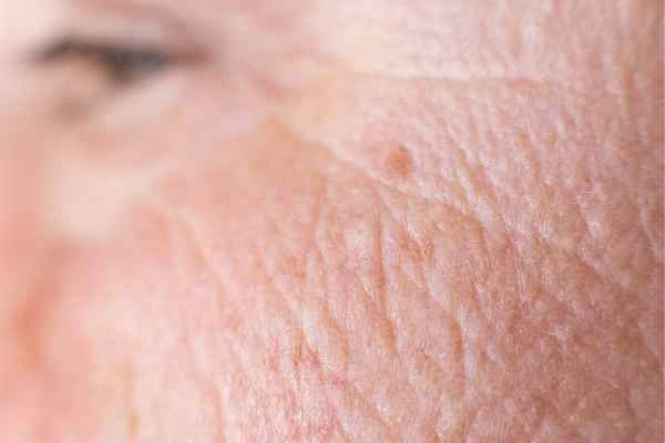 close up picture of a woman's face showing an age spot Darlington