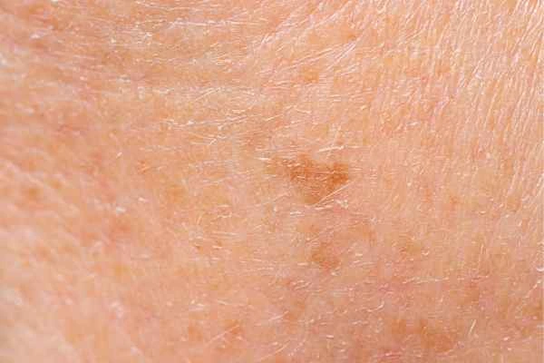 close up picture of age spots Darlington