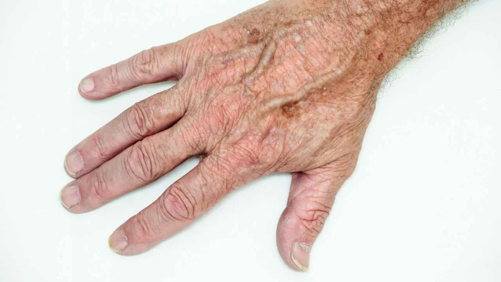 Male hand showing age spot Darlington