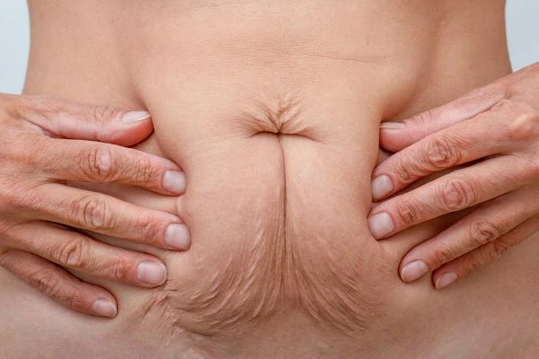 Image of a woman's stomach with loose skin - example of skin tightening Darlington options